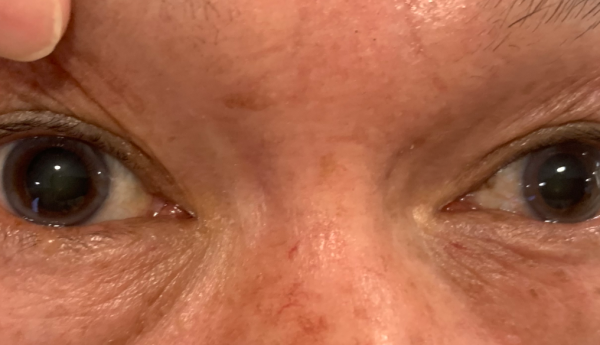 “乱用药” 福建61岁老人误用阿托品缓解眼干，加重白内障病情，永春爱尔眼科呼吁科学护眼