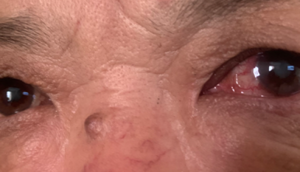 从“眼睛红”到“近乎失明”只隔了半年！永春爱尔眼科提醒：这个“隐形视力杀手”要当心！