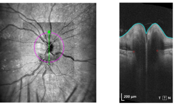 别让感冒 “惹大祸”！17 岁高中生患病后确诊视神经炎