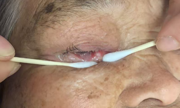 福建八旬奶奶双眼反复流脓红肿，竟是“石头”在作怪！永春爱尔眼科提醒：千万别大意……