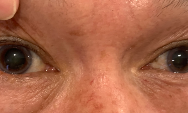 “乱用药” 福建61岁老人误用阿托品缓解眼干，加重白内障病情，永春爱尔眼科呼吁科学护眼