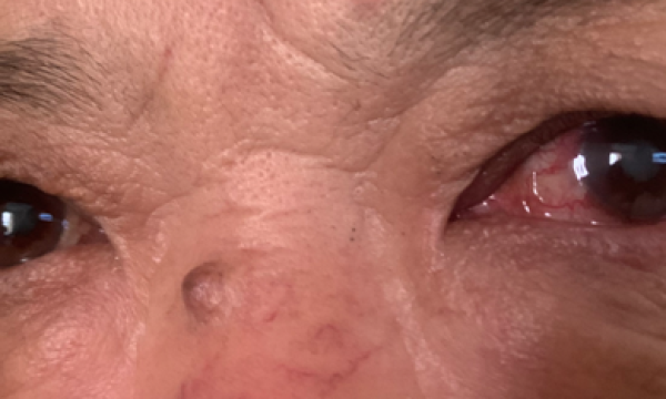 从“眼睛红”到“近乎失明”只隔了半年！永春爱尔眼科提醒：这个“隐形视力杀手”要当心！